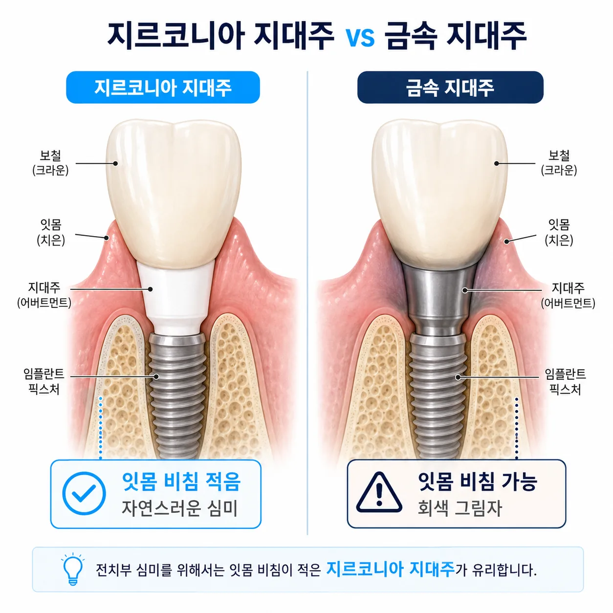 지르코니아 기둥과 금속 기둥의 잇몸 비침 차이 비교