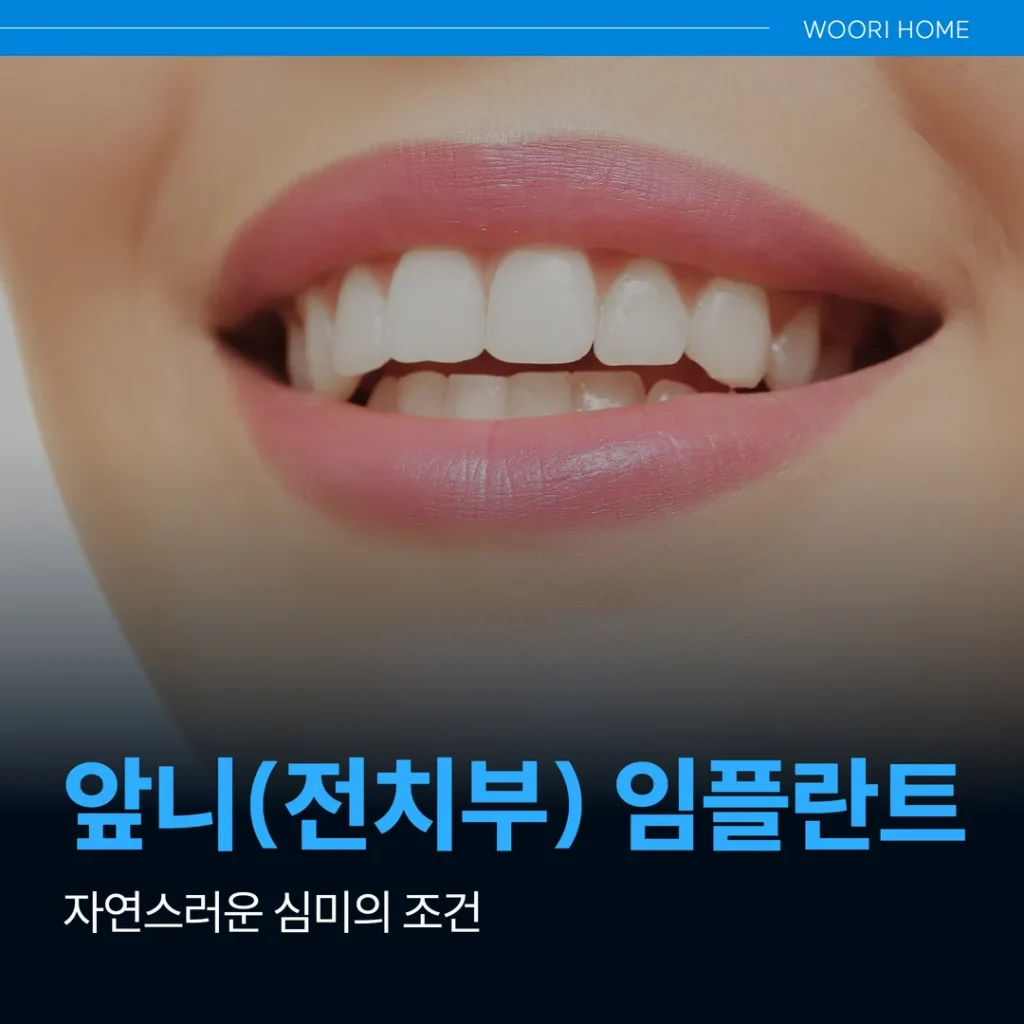 앞니(전치부) 임플란트, 자연스러운 심미의 조건 (울산 남구)