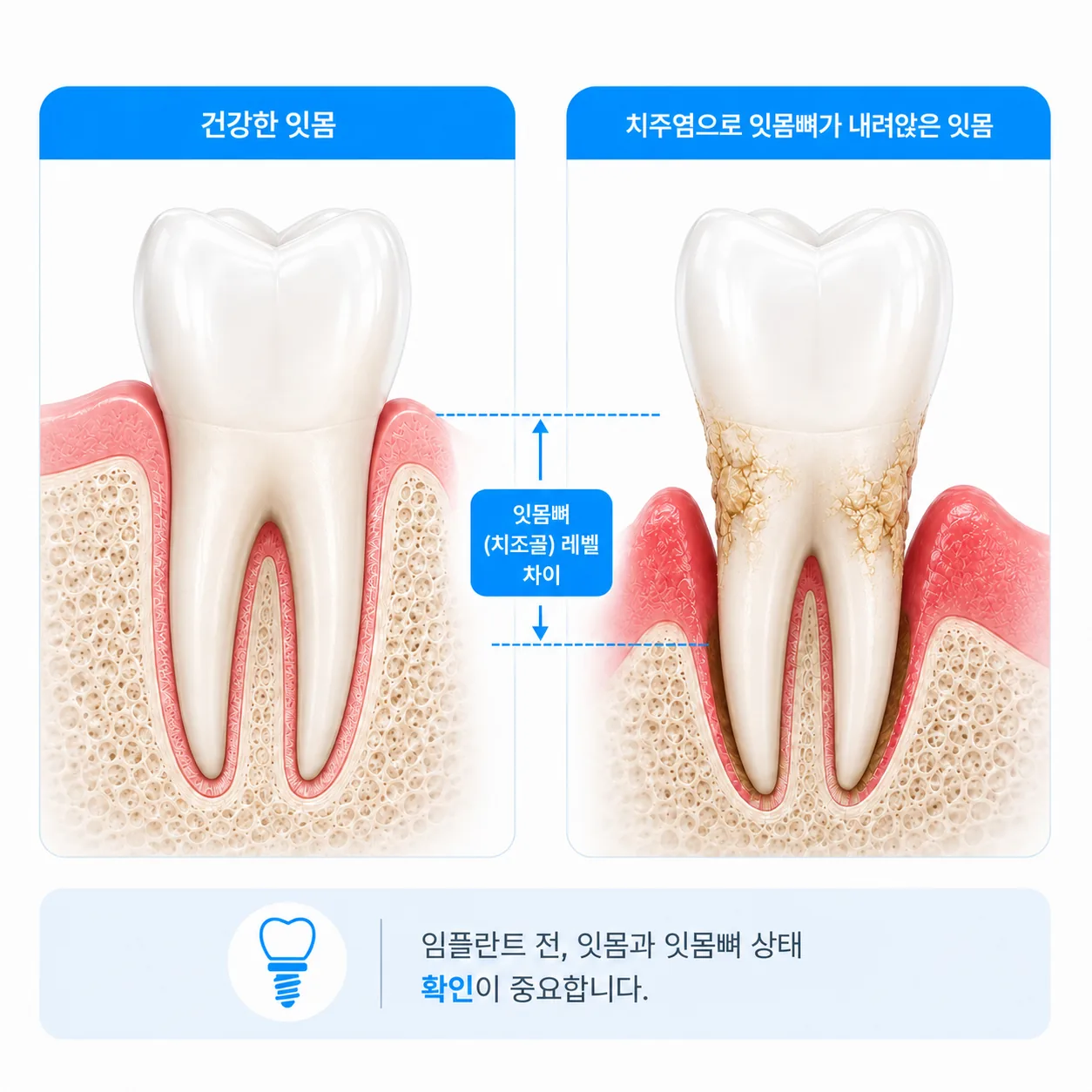 치주염 잇몸과 건강한 잇몸의 잇몸뼈 높이 비교 단면