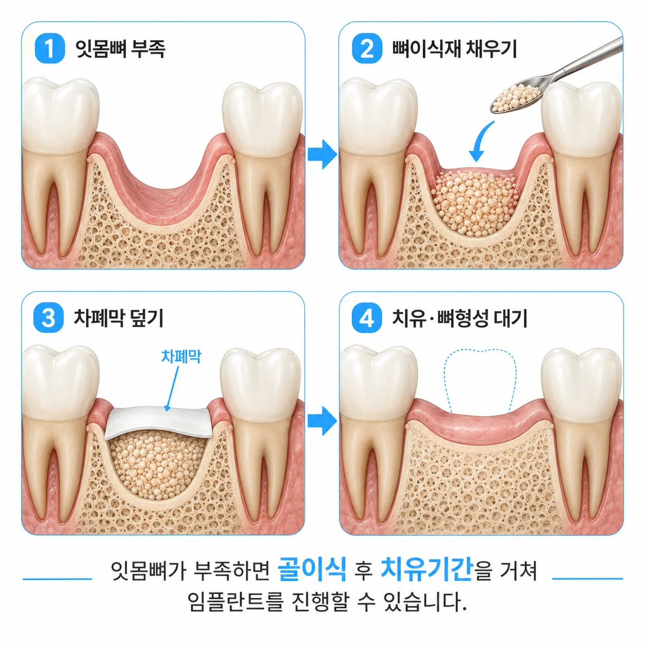 임플란트 골이식 과정 뼈이식재와 차폐막 모식도