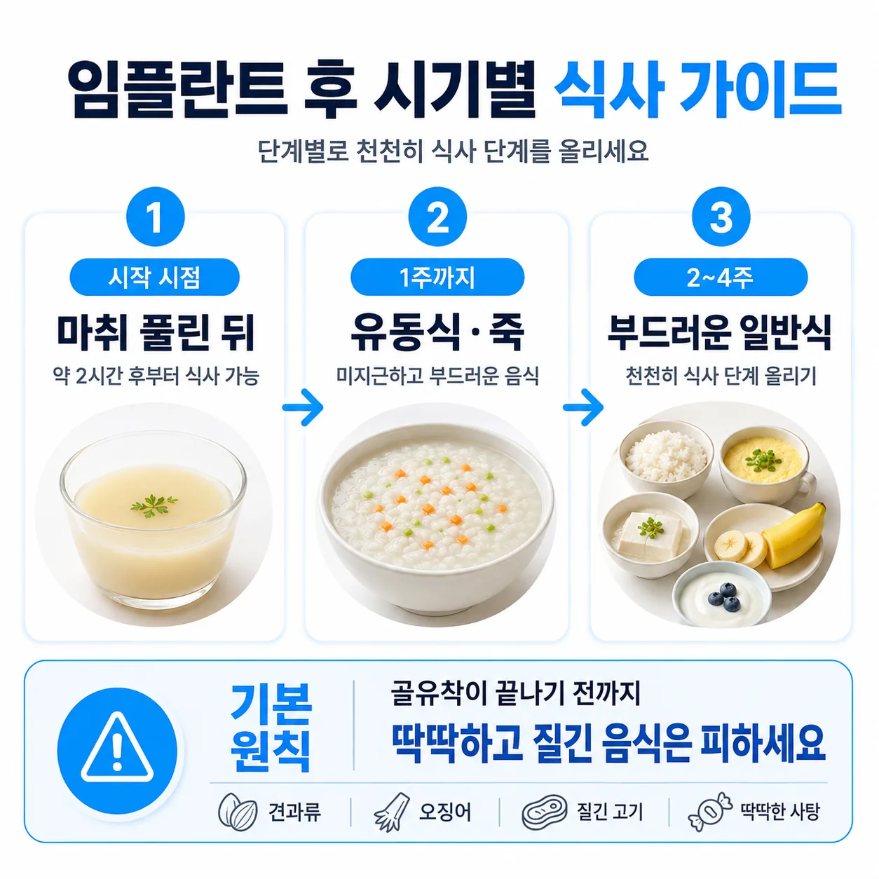 임플란트 후 시기별 음식 단계 안내 인포그래픽
