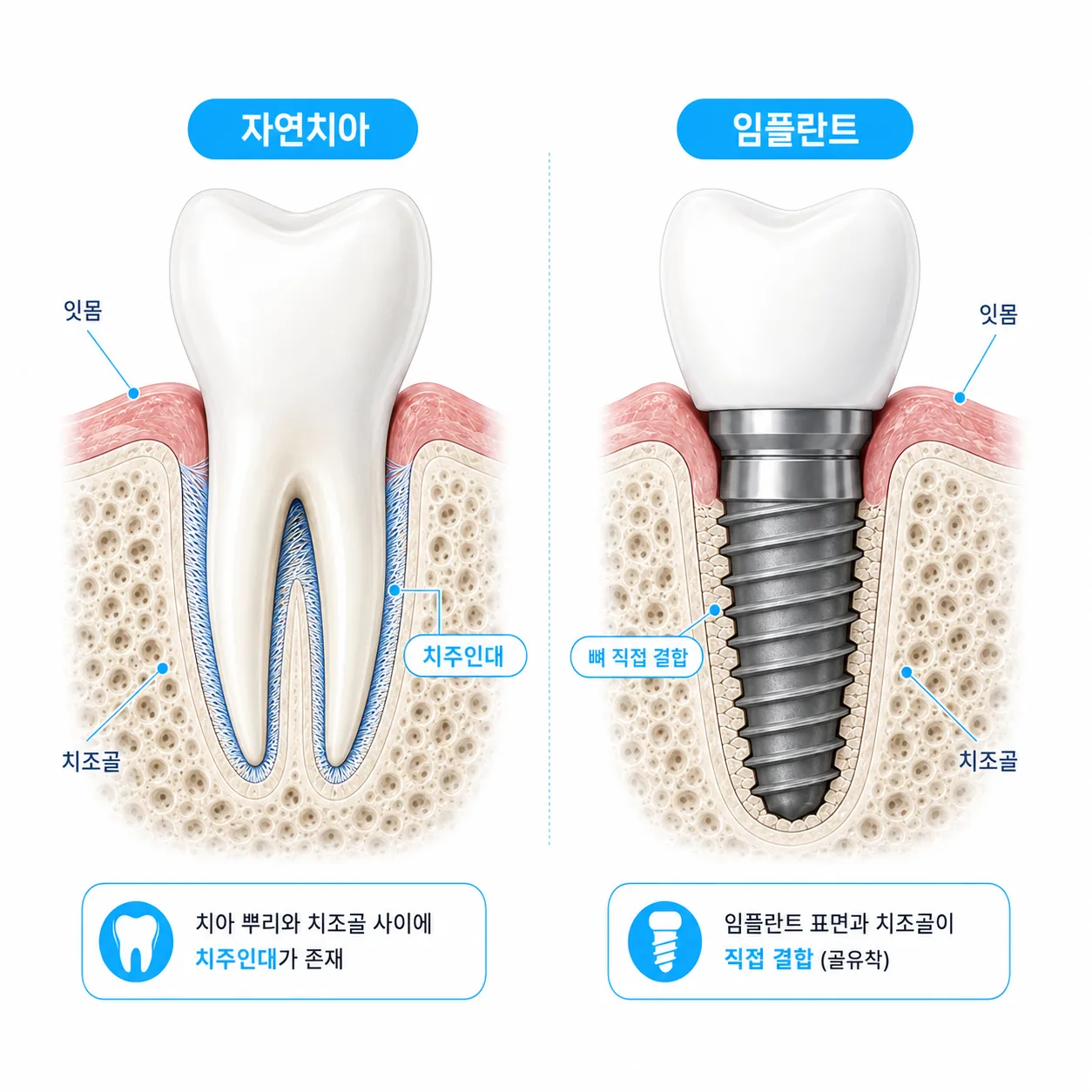 임플란트 주위염 이해를 위한 자연치아와 임플란트 구조 비교 모식도