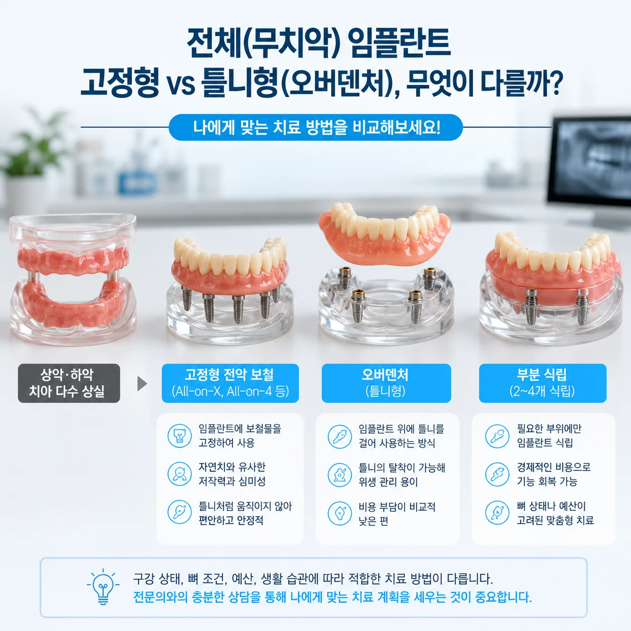 전체 임플란트 세 가지 옵션(고정형 전악 보철, 오버덴쳐, 부분 단계 식립) 구조 비교 모형