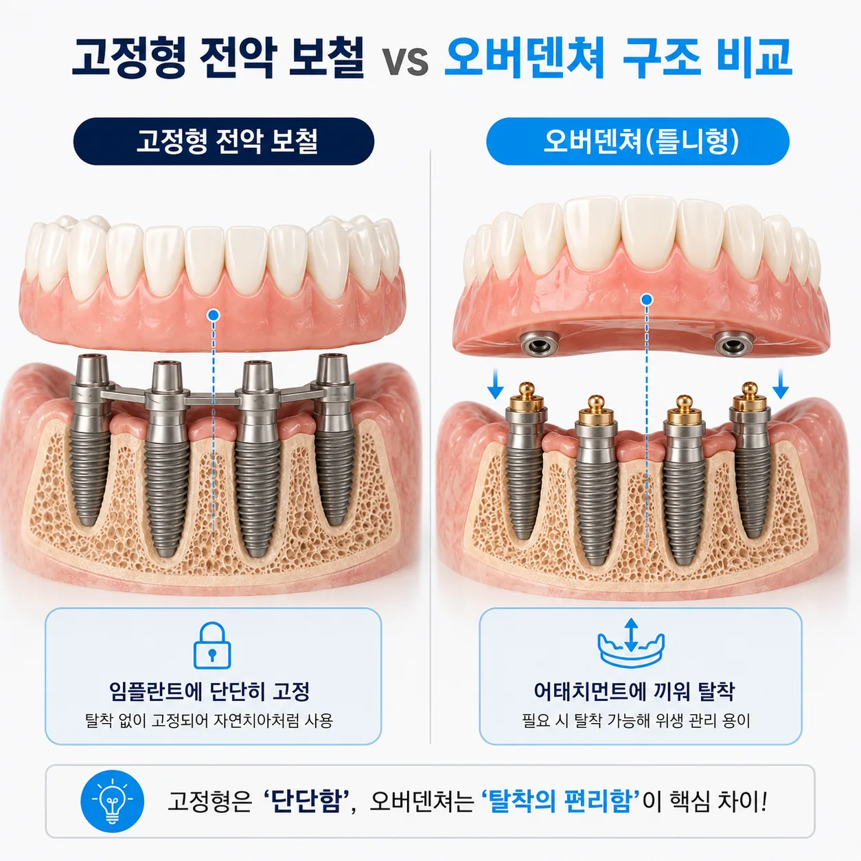 고정형 전악 임플란트 보철과 임플란트 틀니(오버덴쳐) 단면 구조 비교 일러스트