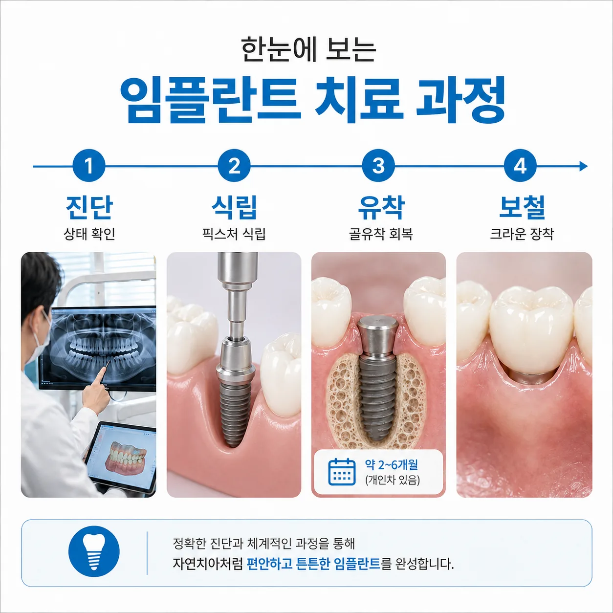 진단, 식립, 유착, 보철로 이어지는 임플란트 치료 단계를 정리한 타임라인