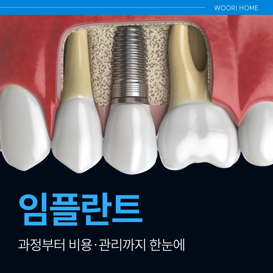 울산 남구 임플란트, 과정부터 비용·관리까지 한눈에
