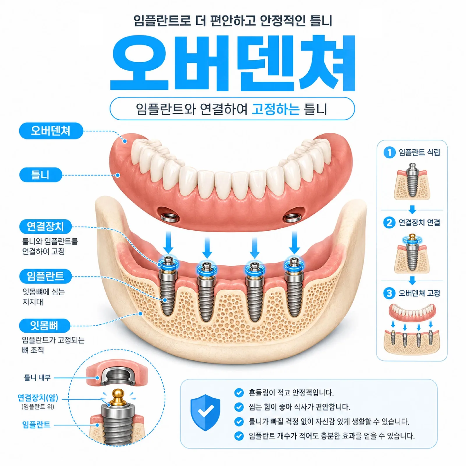 울산 남구 임플란트 틀니 오버덴쳐 구조 개념도