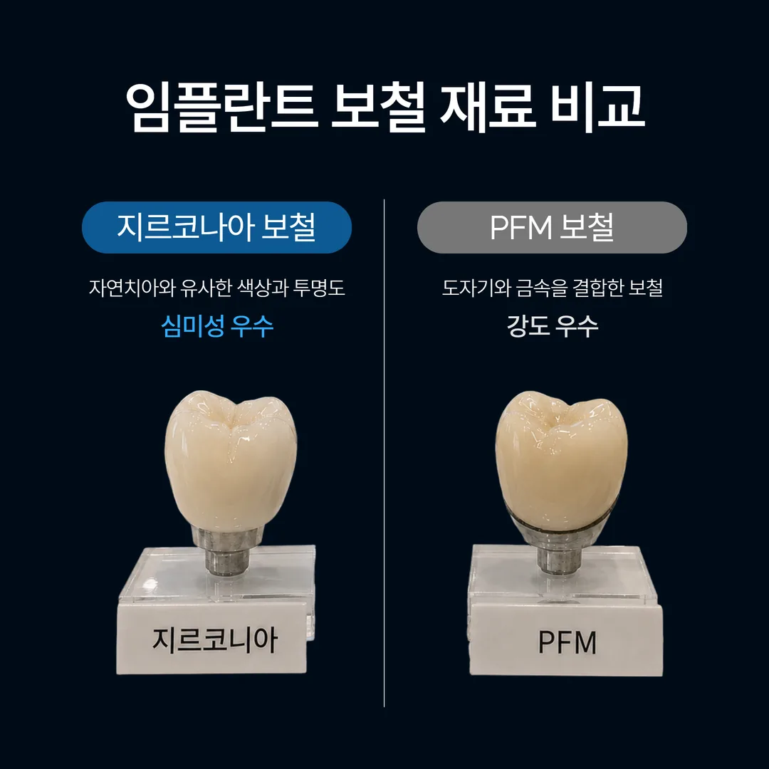지르코니아 PFM 임플란트 보철 재료 비교