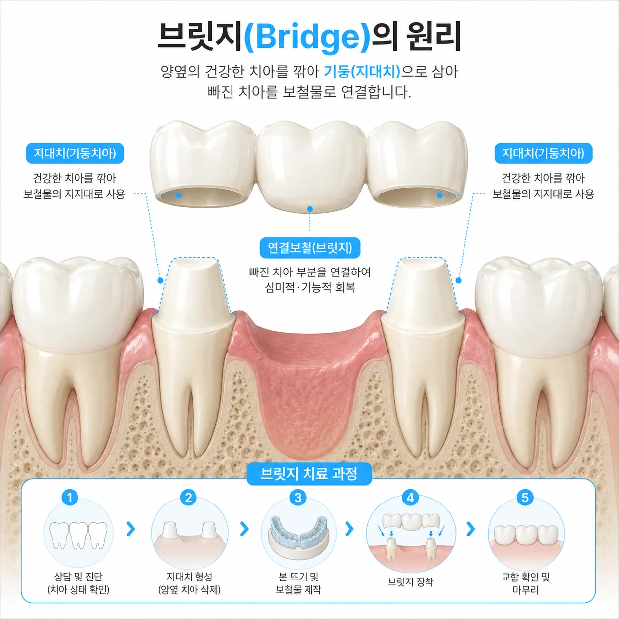 브릿지가 인접 치아를 삭제해 기둥으로 삼는 원리