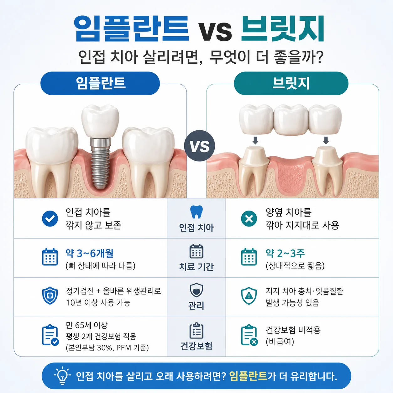 임플란트 브릿지 항목별 비교 요약 인포그래픽