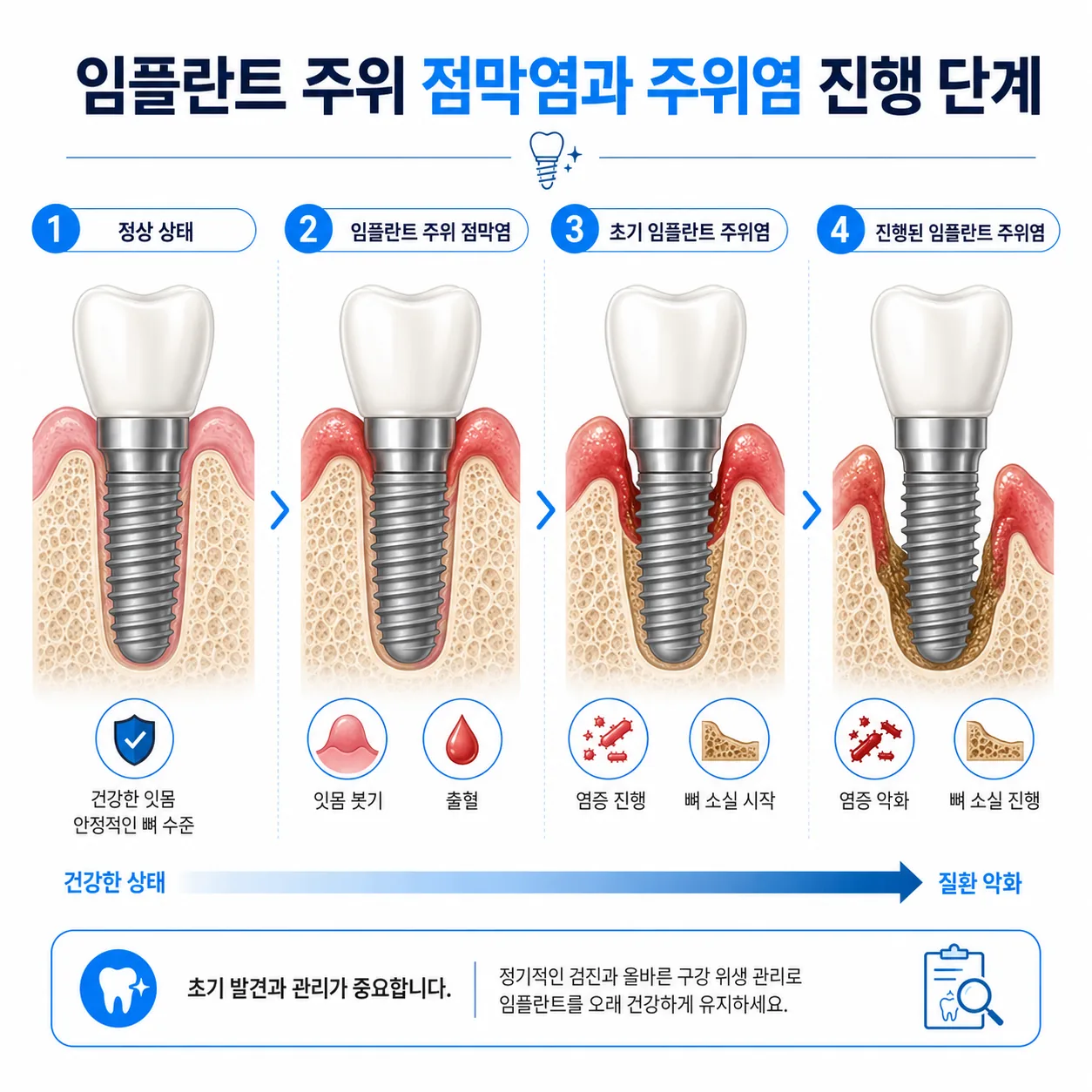 임플란트 주위염 진행 단계와 정기검진 필요성