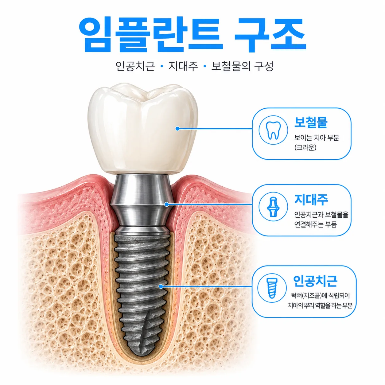 임플란트 인공치근 지대주 보철물 구조 설명