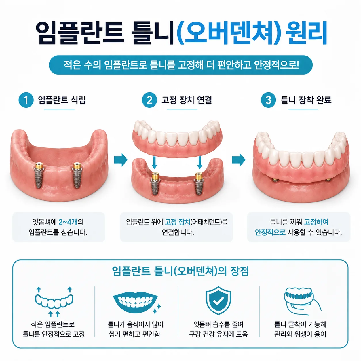 임플란트 틀니 오버덴쳐 고정 원리 일러스트