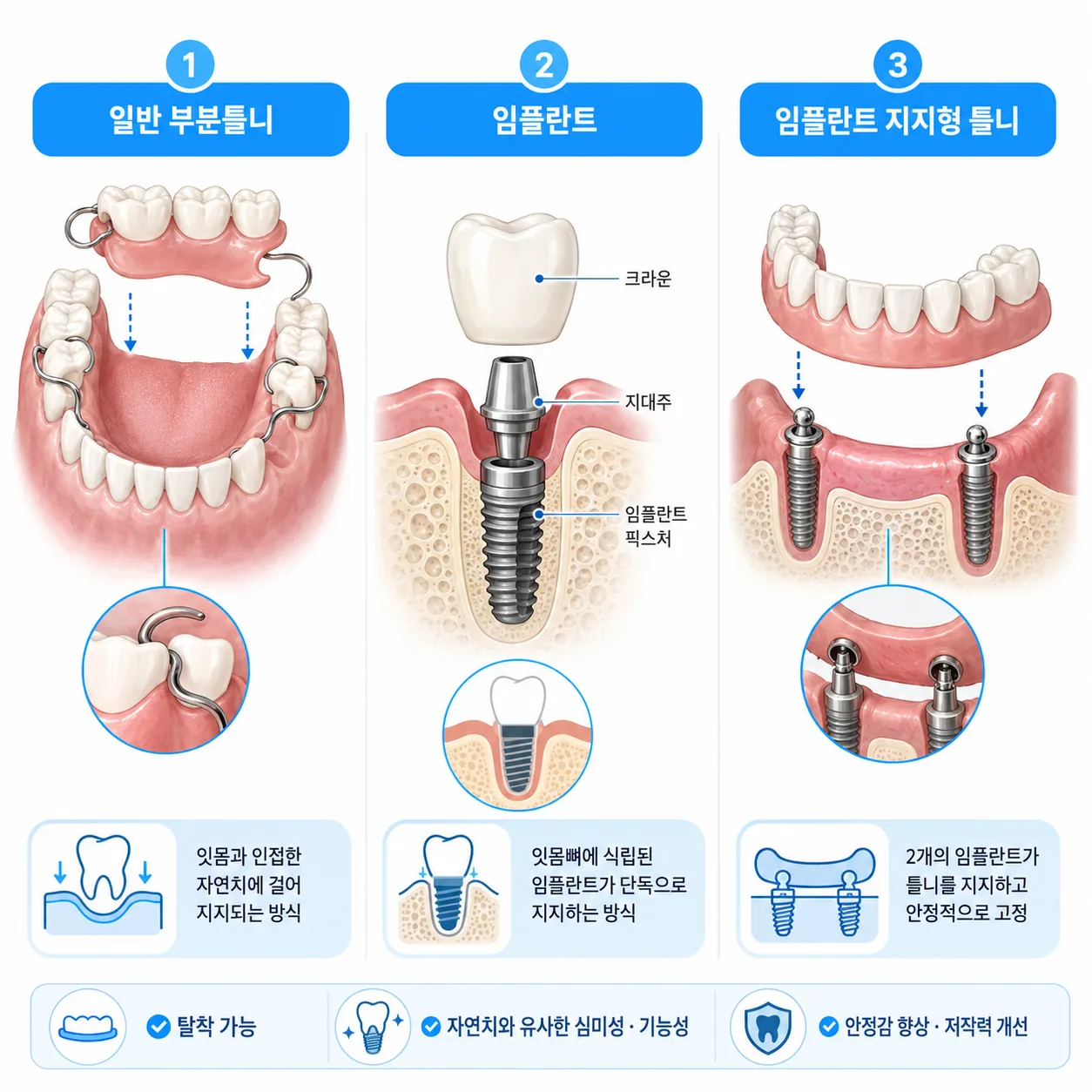 부분틀니 임플란트 임플란트틀니 구조 차이 비교