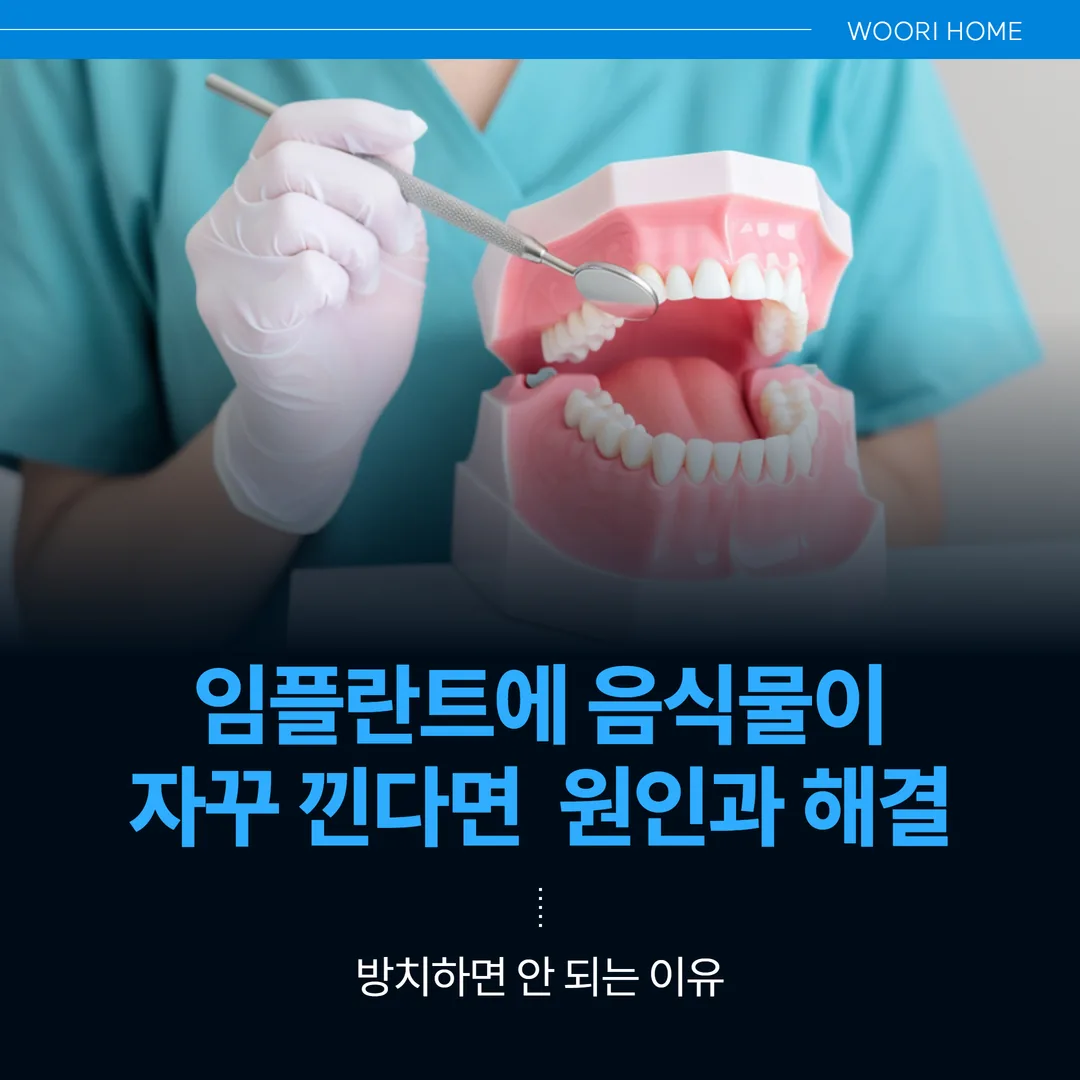 임플란트에 음식물이 자꾸 낀다면 — 원인과 해결, 방치하면 안 되는 이유 (울산 남구)
