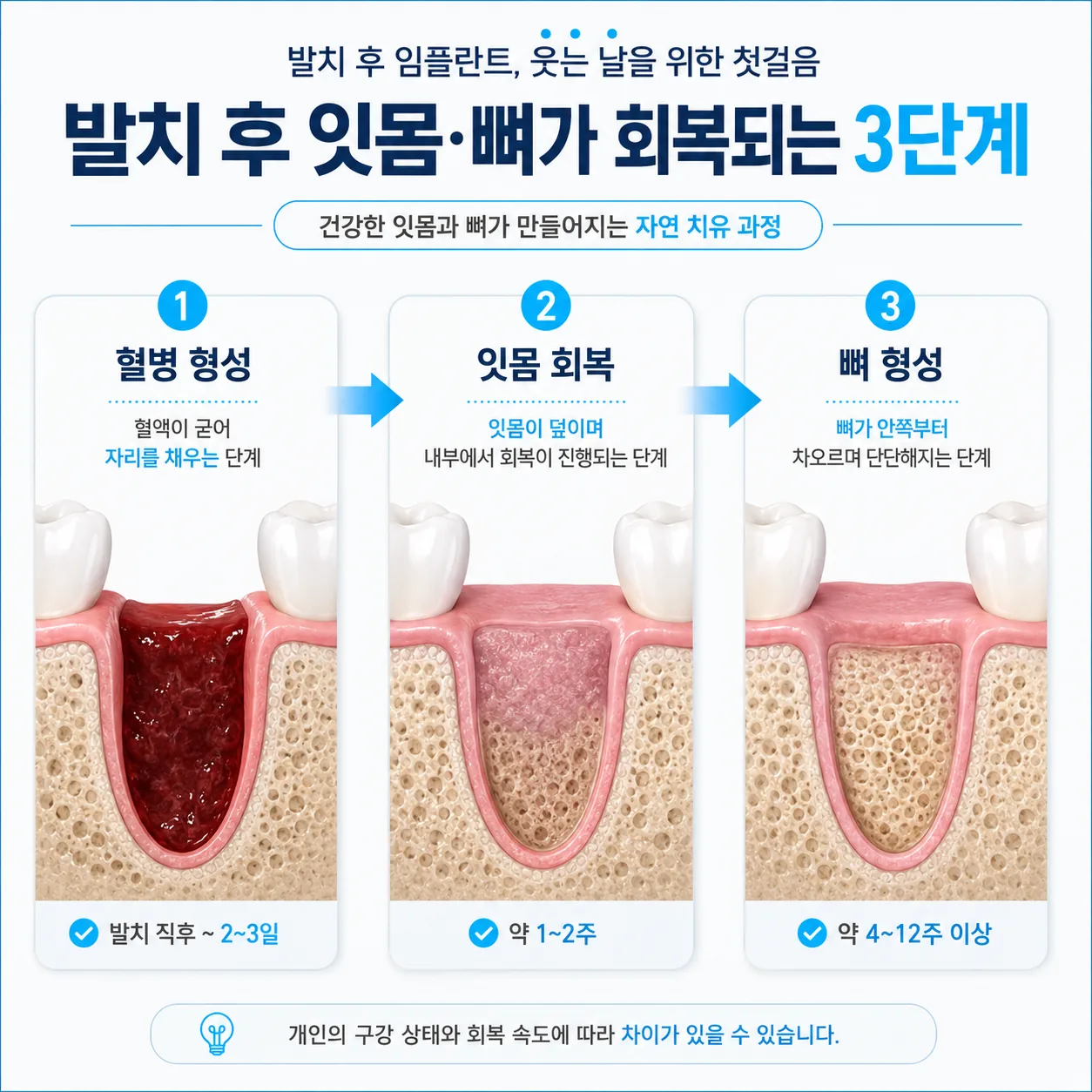 발치 후 발치와가 아무는 세 단계 — 혈액 응고, 연조직 치유, 골 재형성 과정 도해