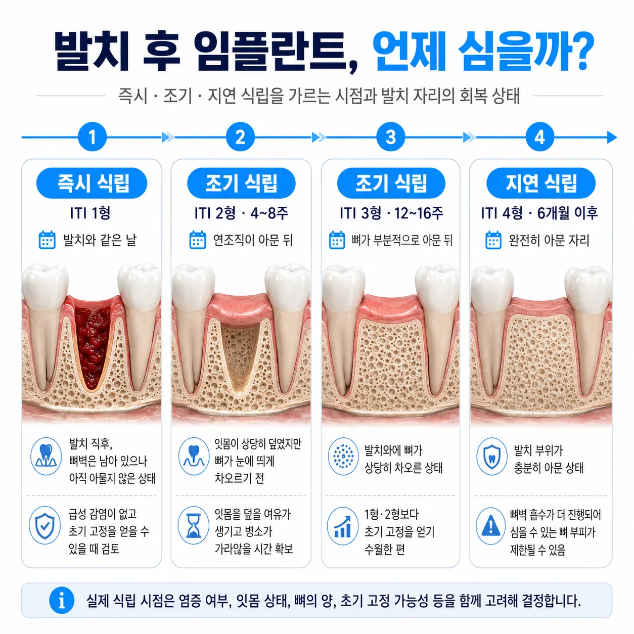 즉시·조기·지연 임플란트 식립 시점을 발치 후 경과에 따라 표시한 타임라인 도해