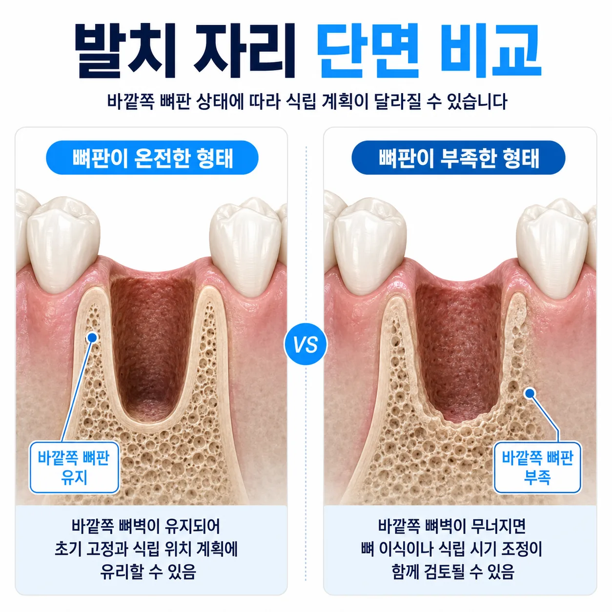 발치와의 바깥쪽 뼈판이 온전한 경우와 결손이 있는 경우를 비교한 단면 도해