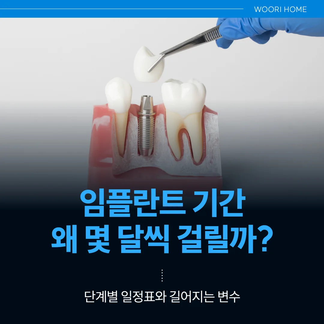 임플란트 기간, 왜 몇 달씩 걸릴까 — 단계별 일정표와 길어지는 변수