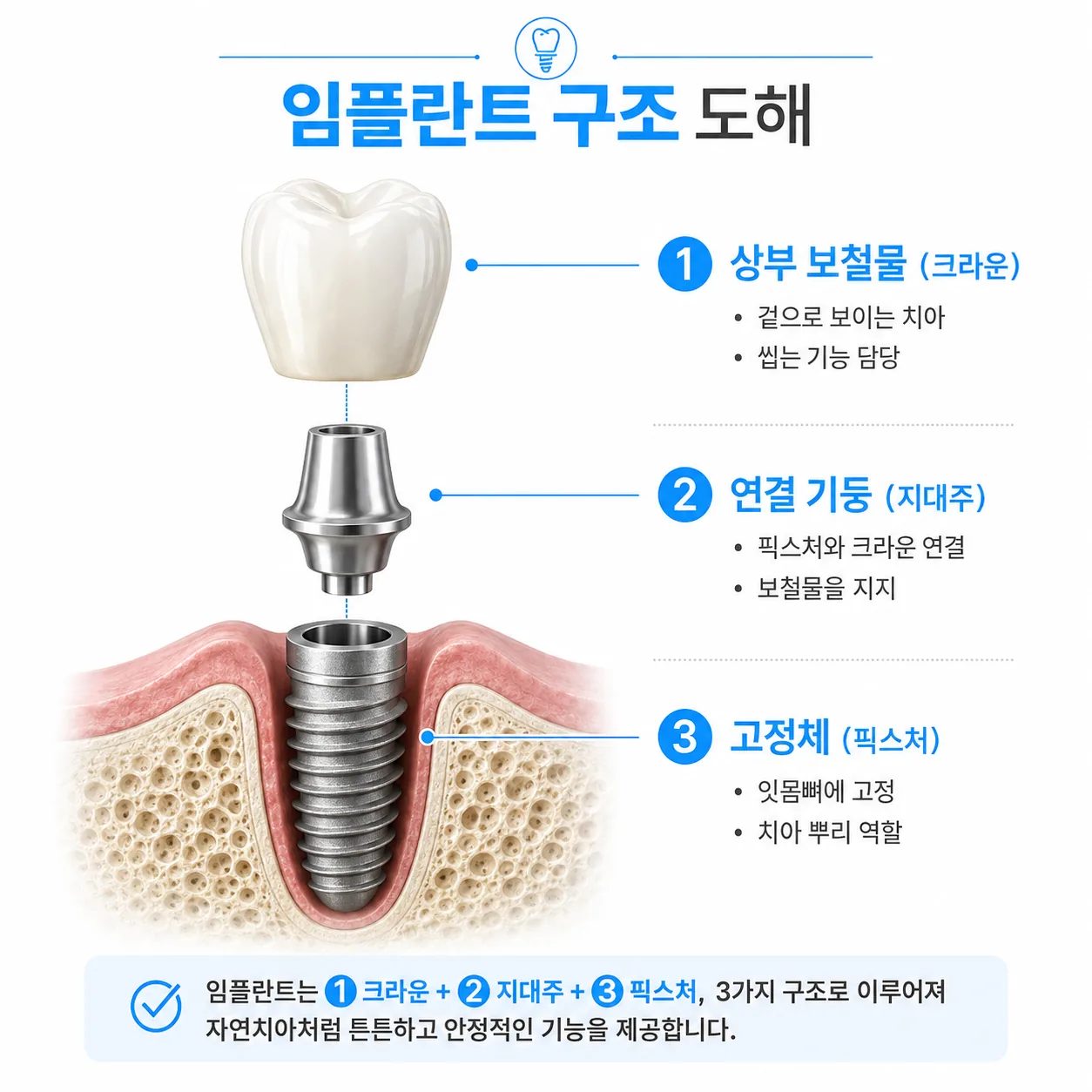 임플란트 구조 세 부분과 각 부품의 역할 도해