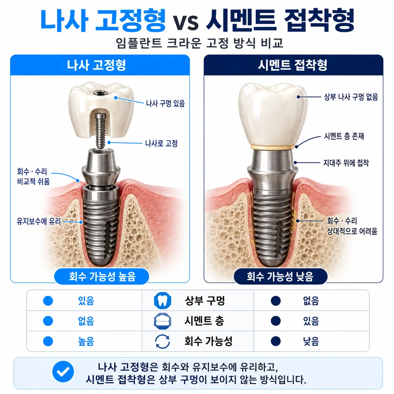 나사 고정형과 시멘트 접착형 임플란트 크라운 비교 도해