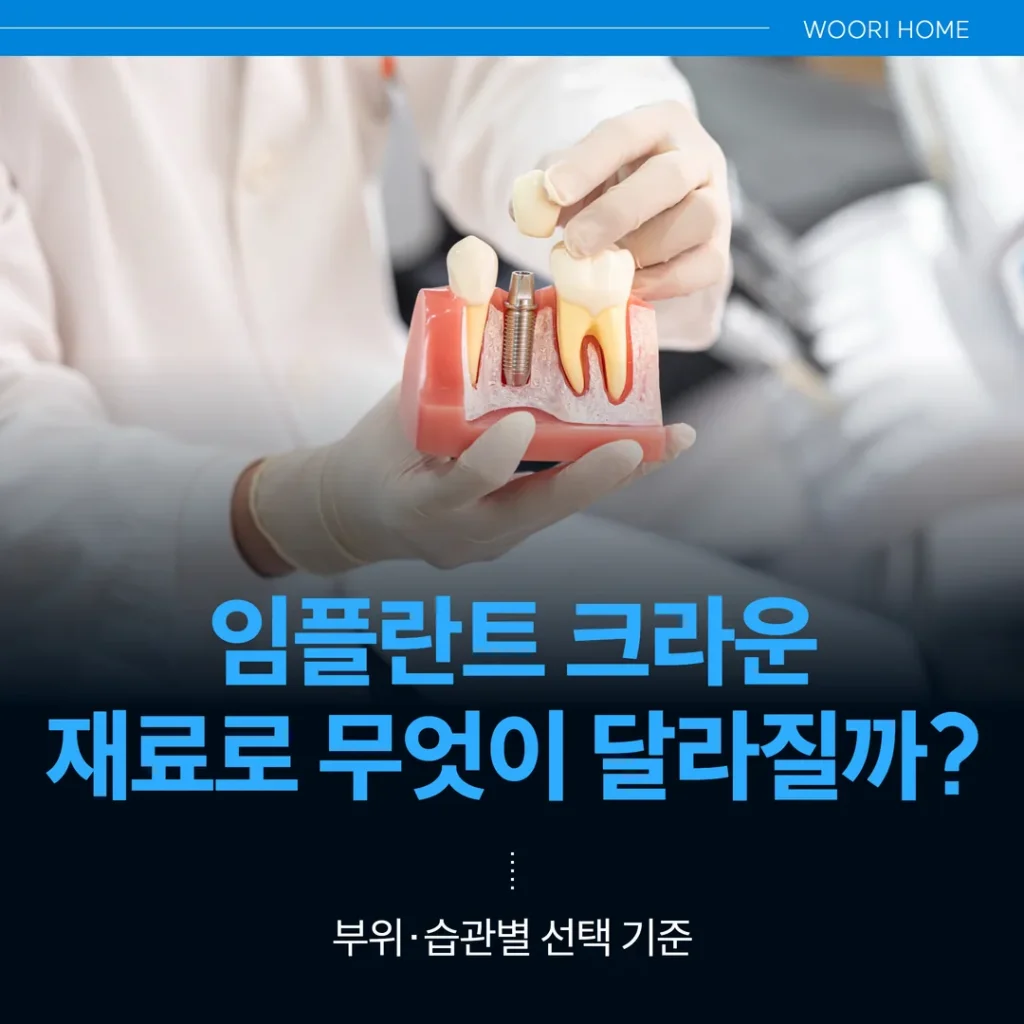임플란트 크라운(상부 보철), 재료로 무엇이 달라질까 — 부위·습관별 선택 기준