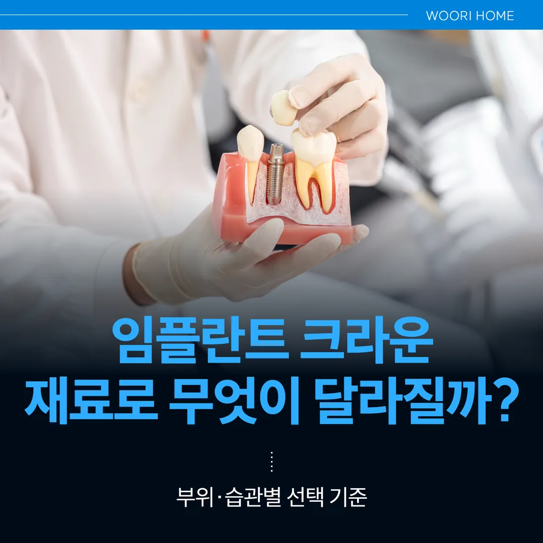 임플란트 크라운(상부 보철), 재료로 무엇이 달라질까 — 부위·습관별 선택 기준