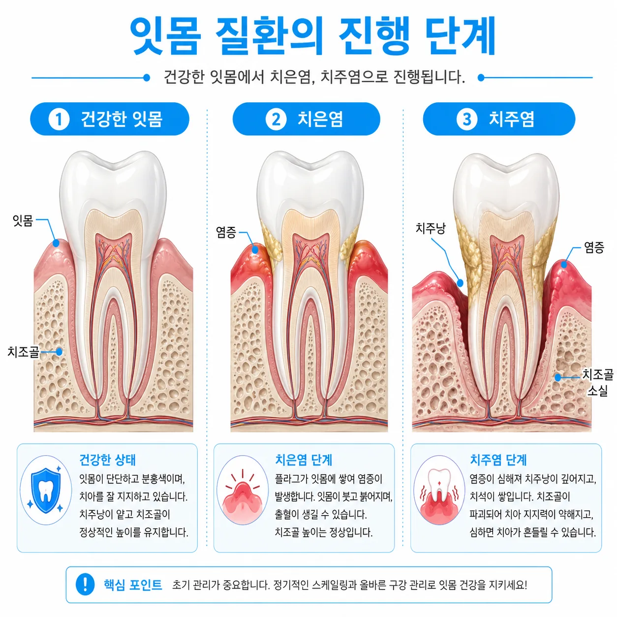 치은염과 치주염의 차이를 보여주는 잇몸 단면 비교 그림