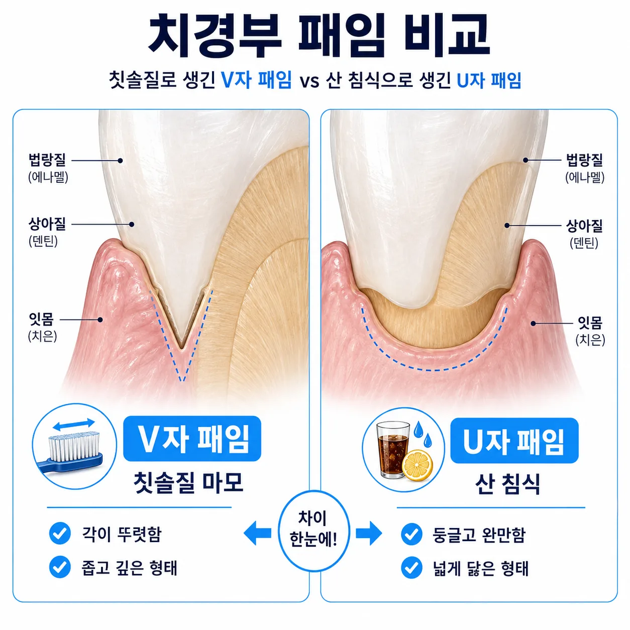칫솔질로 생긴 V자 패임과 산 침식으로 생긴 U자 패임 비교 도해
