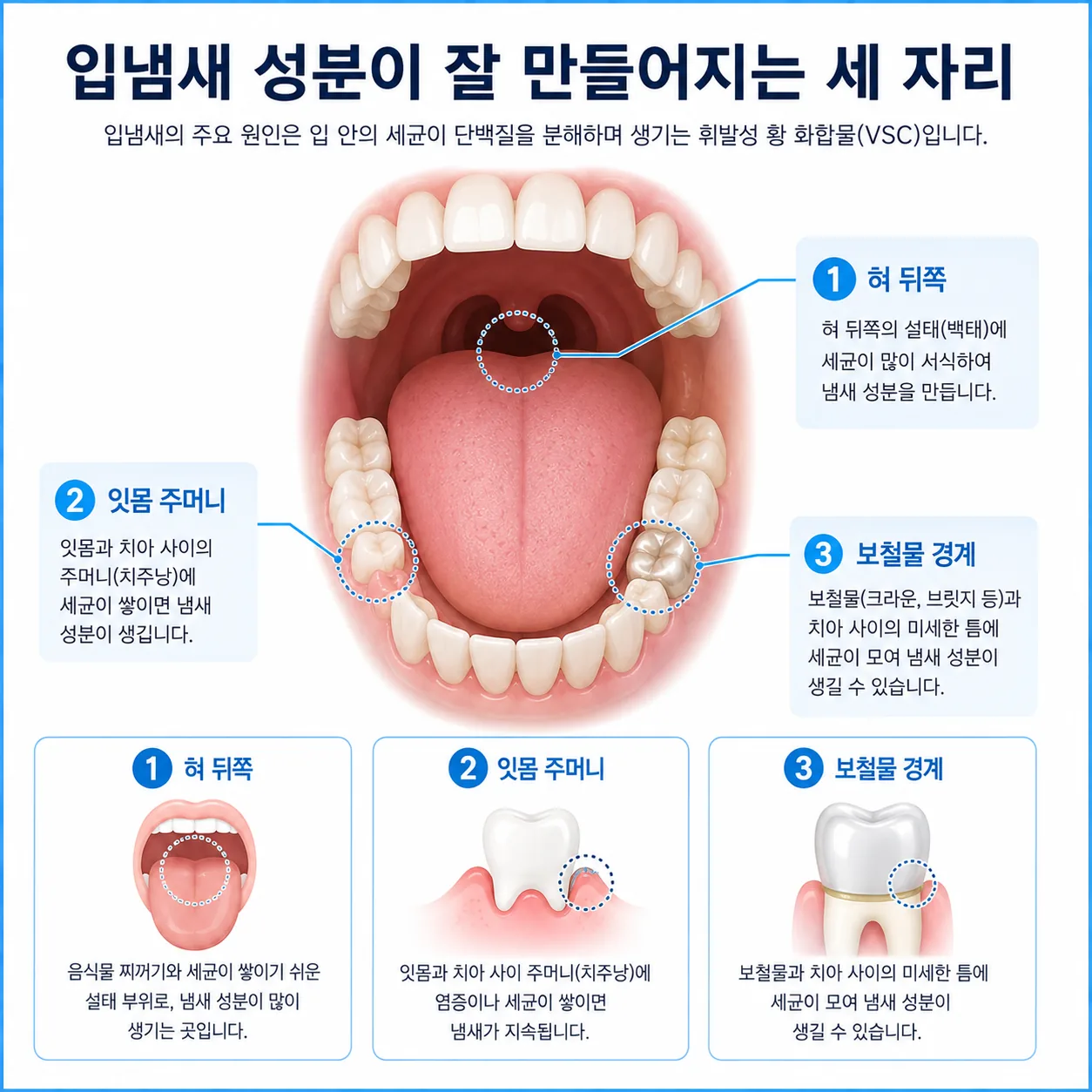 혀 뒤쪽, 잇몸 주머니, 보철물 경계를 표시한 입 안 단면 도해