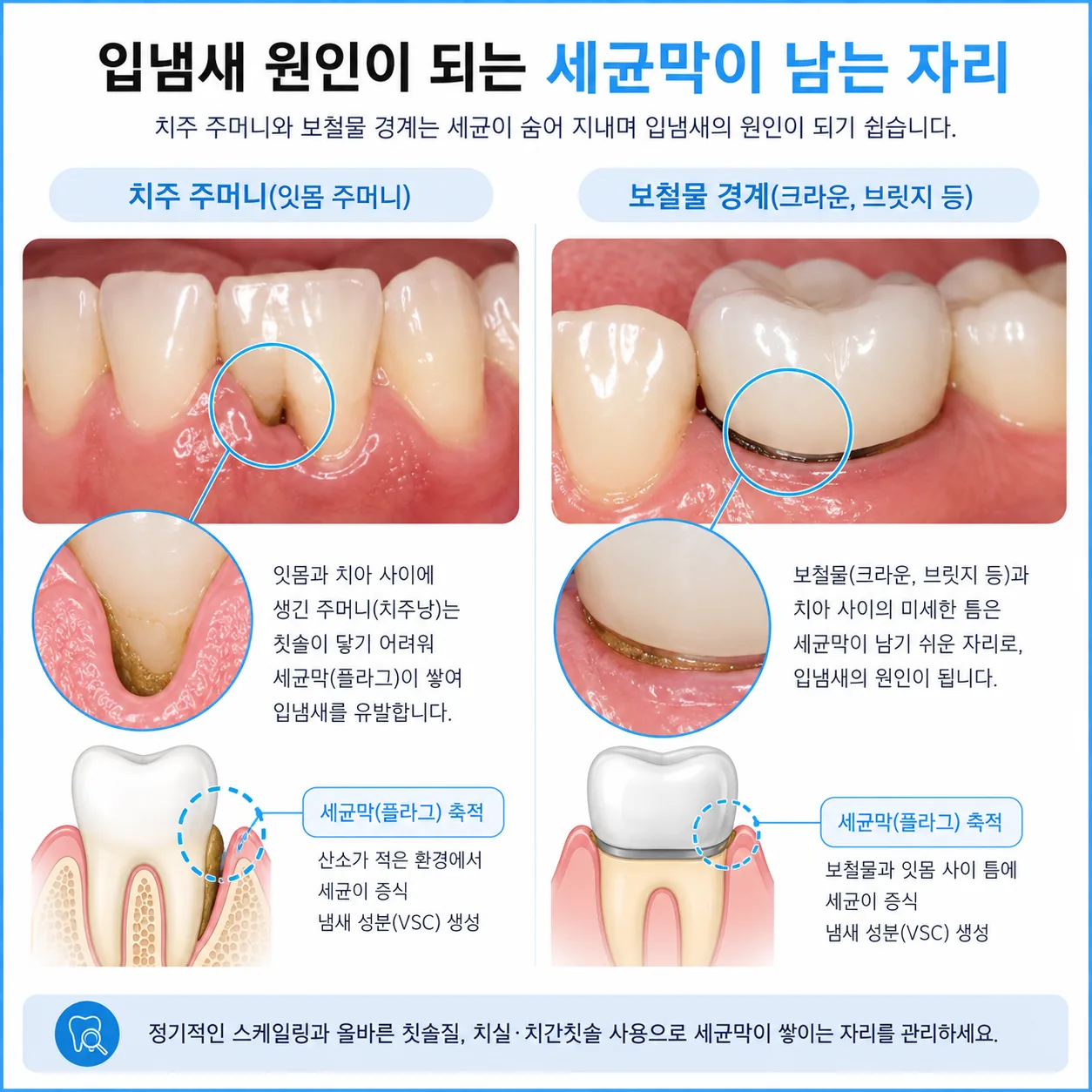 잇몸 주머니와 크라운 경계에 세균막이 남는 위치를 비교한 도해
