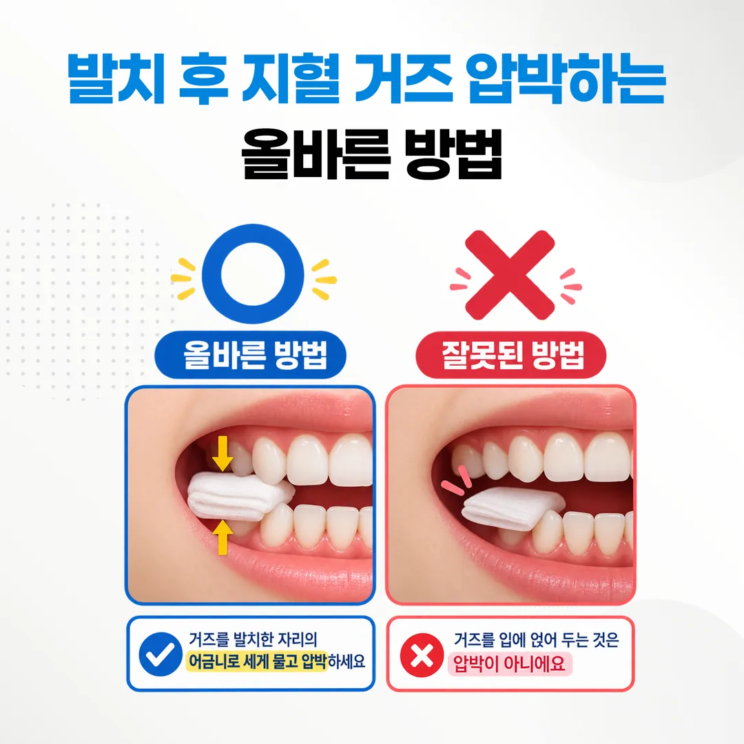 발치 후 지혈 거즈 압박하는 올바른 방법