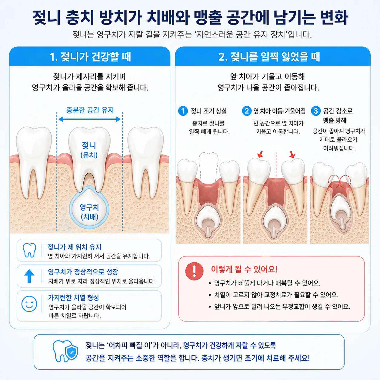 유치 충치 방치가 치배와 맹출 공간에 남기는 변화 단면 도해