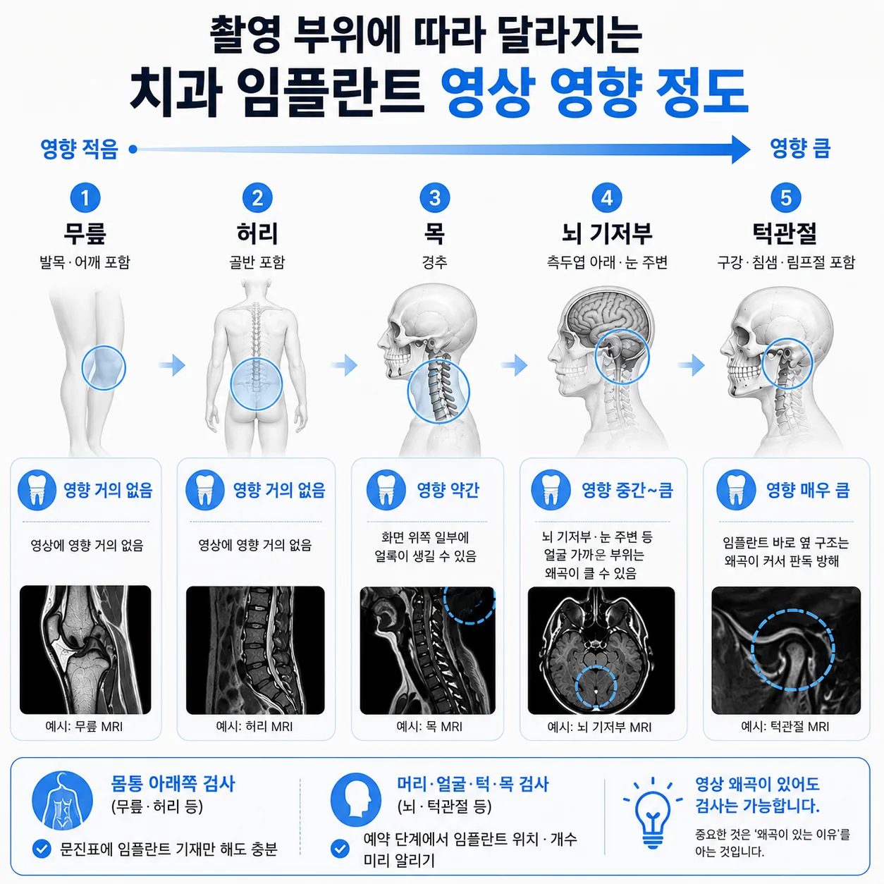 촬영 부위별 치과 임플란트 영상 왜곡 영향 범위 그림