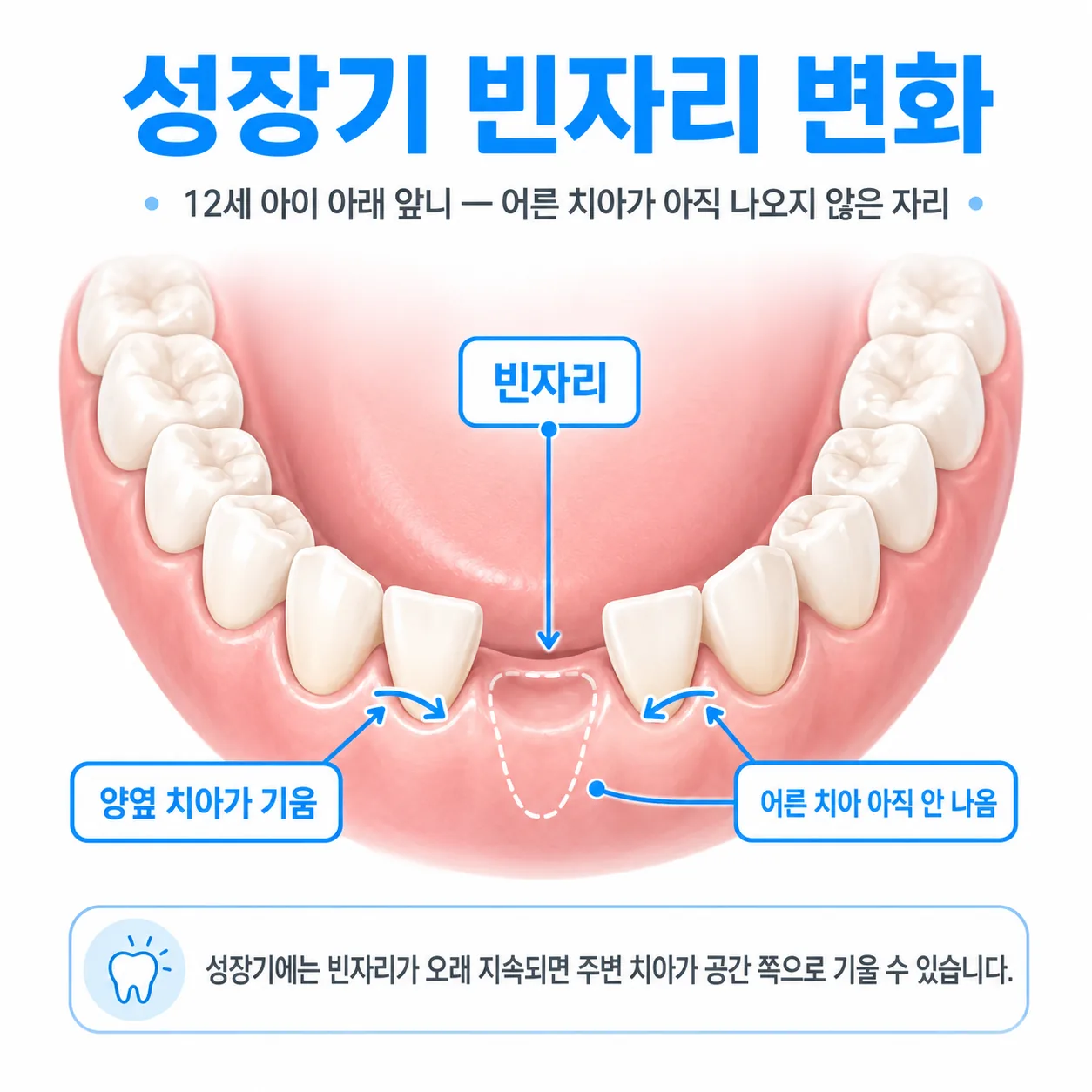어른 치아가 아직 나오지 않은 빈자리와 양옆으로 기운 치아