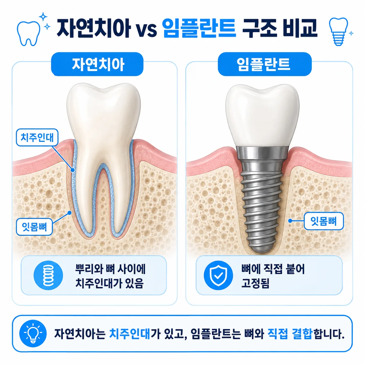 치주인대가 있는 자연치아와 뼈에 직접 붙는 임플란트 구조 비교