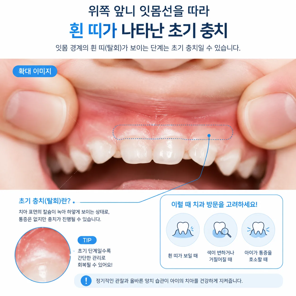 아이 위쪽 앞니 잇몸선을 따라 흰 띠가 나타난 초기 충치
