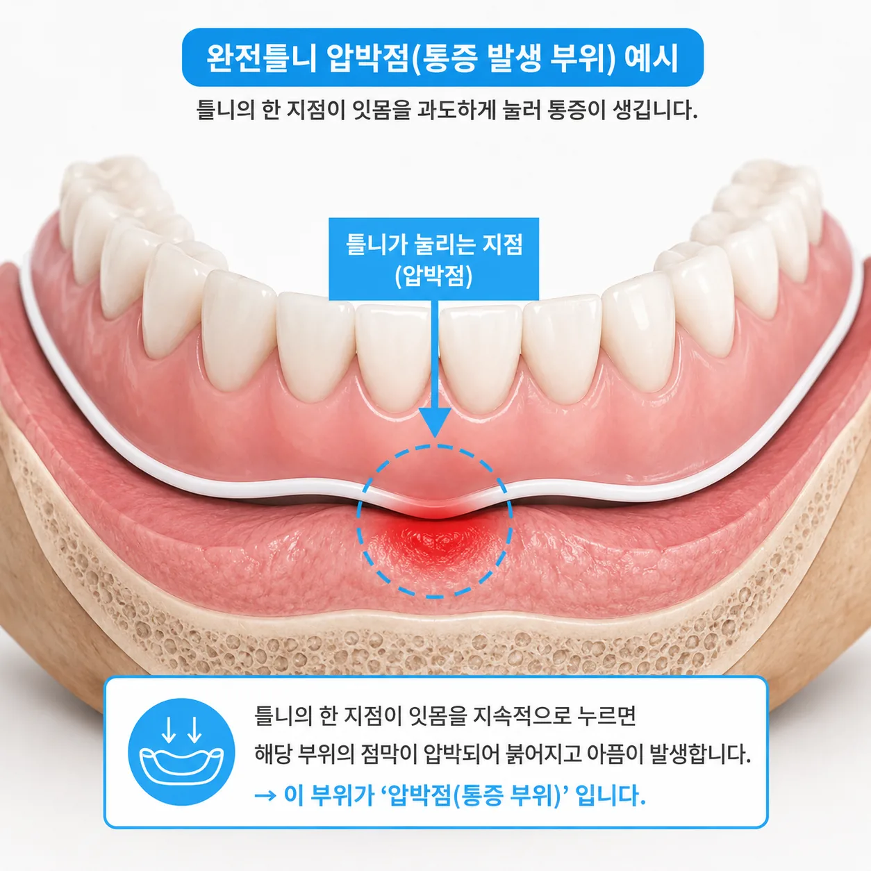 틀니 압박점이 생기는 위치를 보여 주는 잇몸 단면 그림