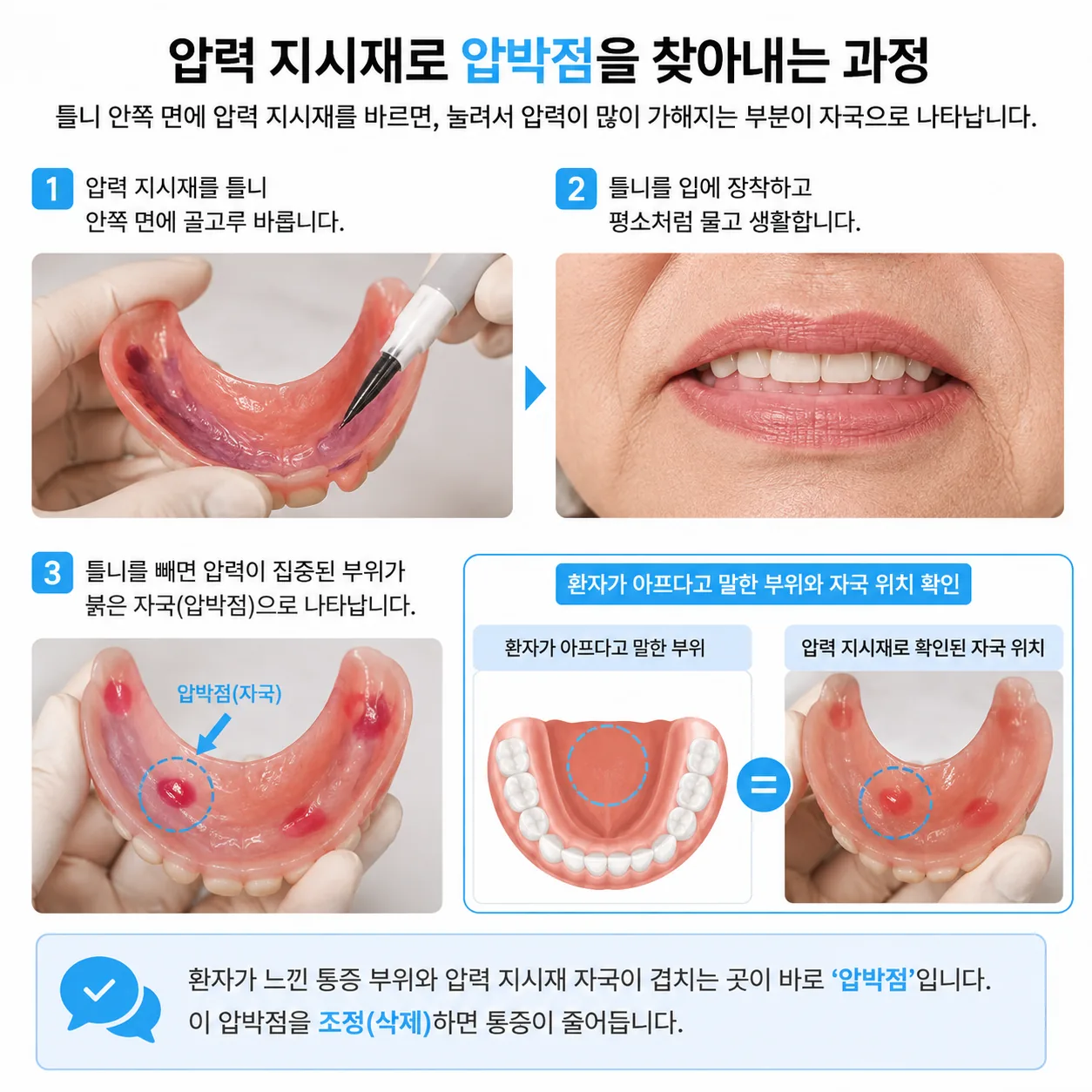 압력 지시재로 틀니 안쪽의 압박점을 찾아내는 과정