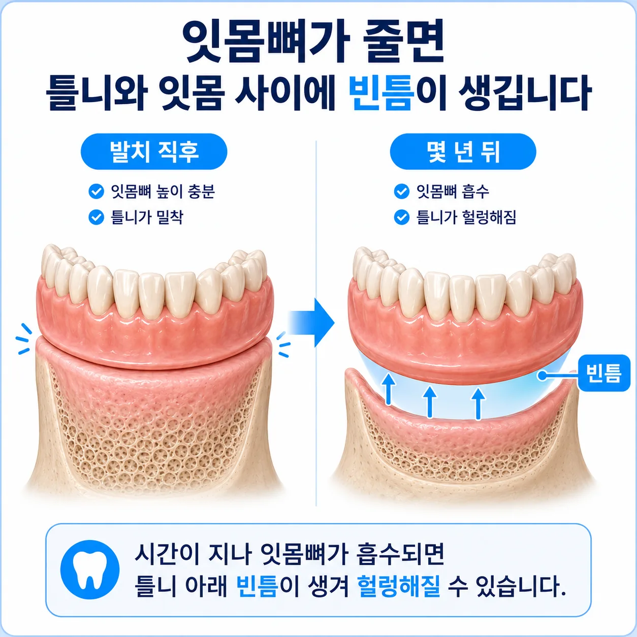 잇몸뼈 흡수로 틀니와 잇몸 사이에 빈틈이 생기는 과정 비교
