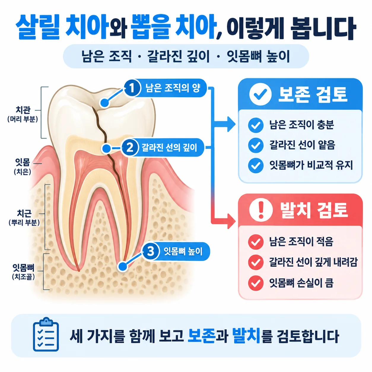 치아에 남은 조직·갈라진 선의 깊이·잇몸뼈 높이 세 가지로 보존과 발치를 가르는 개념도