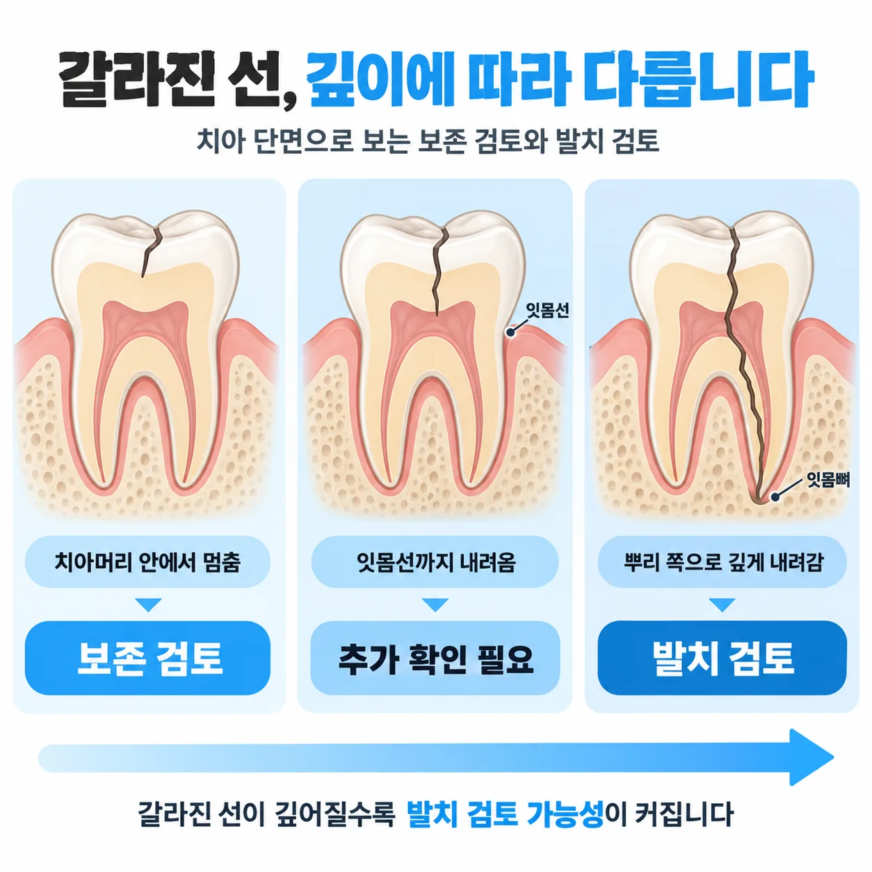 갈라진 선이 멈춘 위치에 따라 보존 검토와 발치 검토로 갈리는 치아 단면 도해