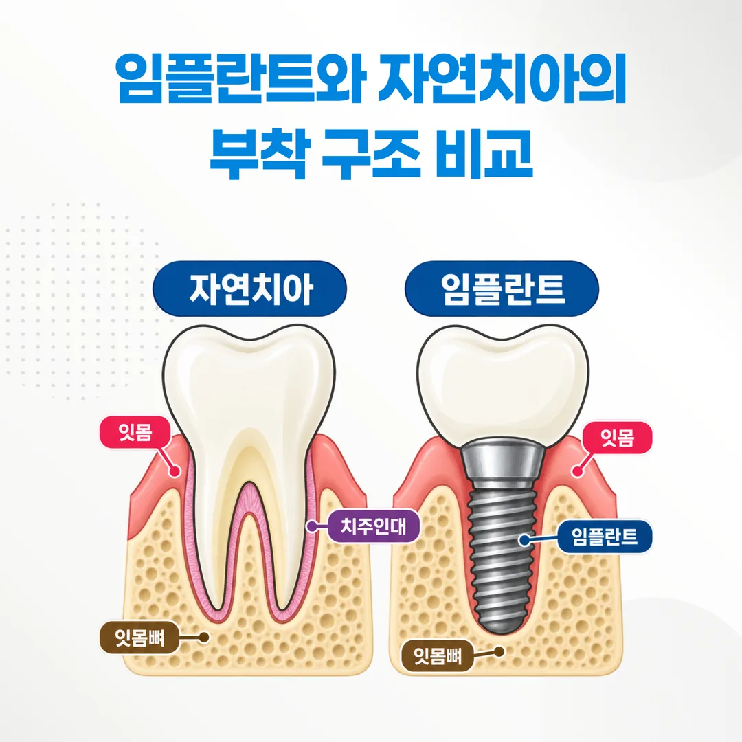 임플란트와 자연치아의 잇몸·뼈 부착 구조를 비교한 단면 개념도