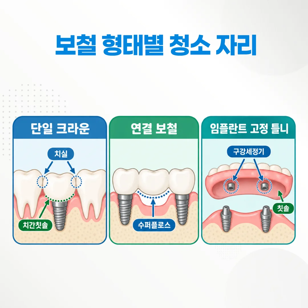 보철 형태별로 청소 도구가 닿아야 하는 자리를 표시한 비교 도식