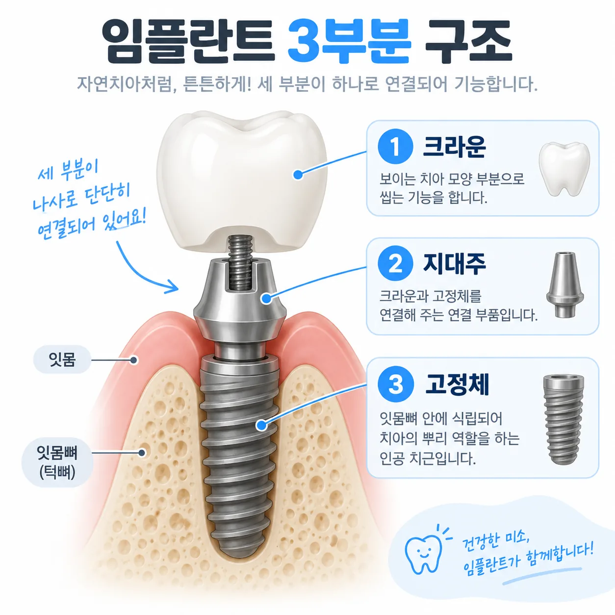 임플란트 고정체 지대주 크라운 세 부분 구조 개념도