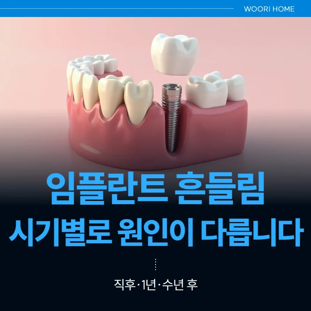 임플란트 흔들림, 시기별로 원인이 다릅니다 — 직후·1년·수년 후