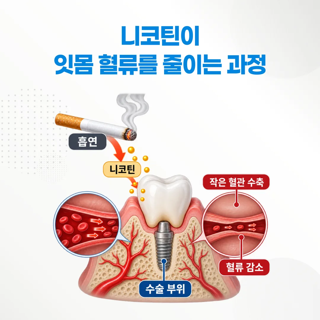 니코틴이 잇몸 혈류를 줄이는 과정을 나타낸 개념도