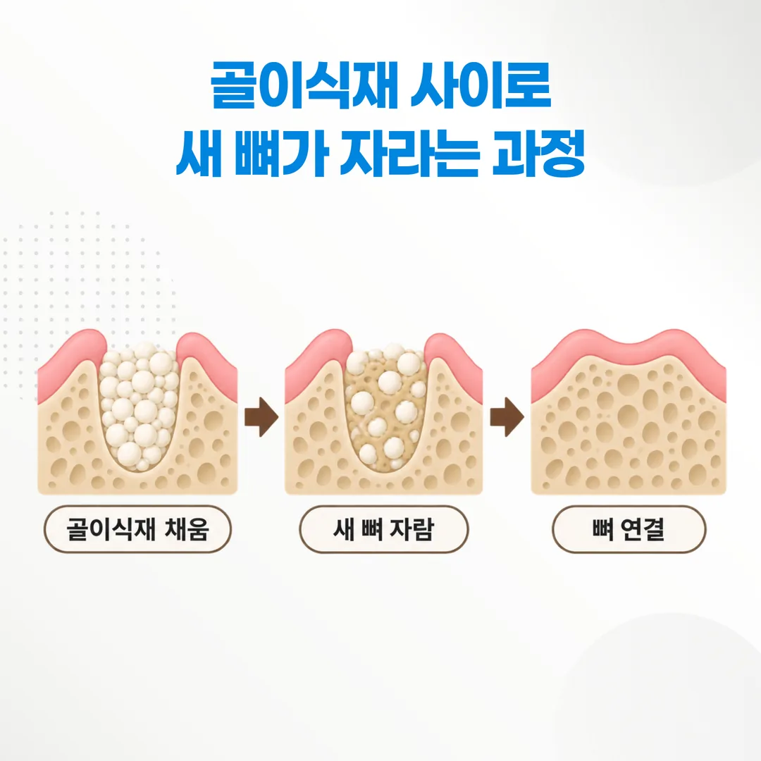 골이식재가 지지체 역할을 하며 새 뼈가 자라 들어오는 과정을 세 단계로 보여주는 개념도