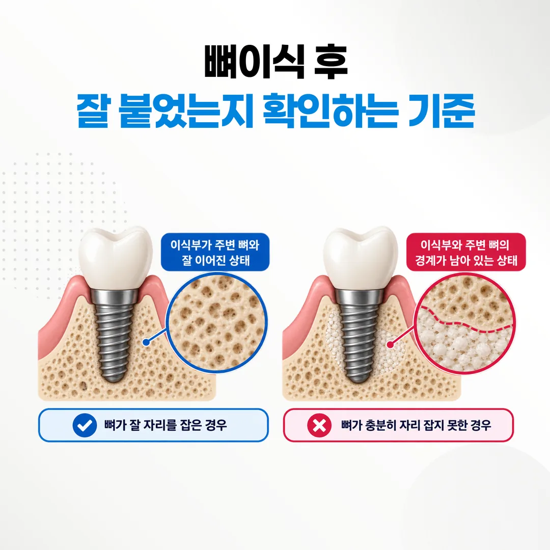 이식부가 주변 뼈와 이어졌는지 판독하는 기준을 나란히 비교한 개념도