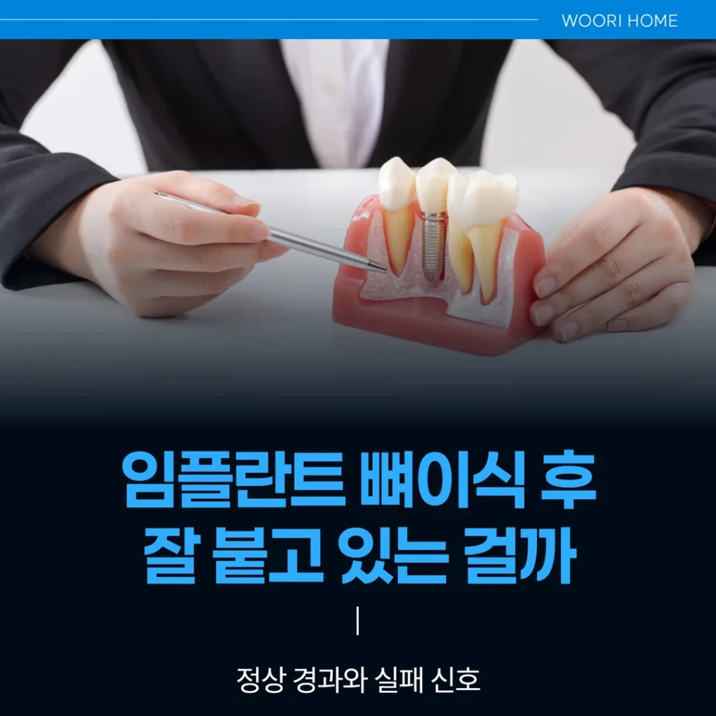 임플란트 뼈이식 후, 잘 붙고 있는 걸까 — 정상 경과와 실패 신호